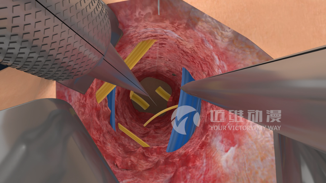 醫(yī)學(xué)手術(shù)三維動(dòng)畫(huà) 醫(yī)學(xué)手術(shù)三維動(dòng)畫(huà)